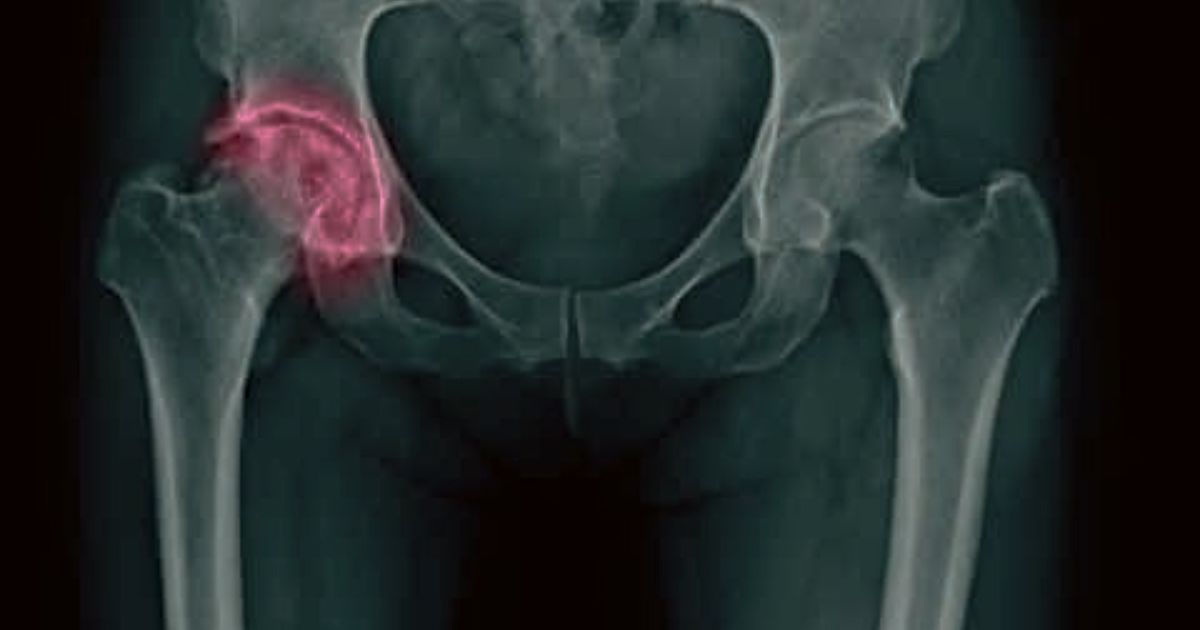 La fuerza muscular podría predecir el riesgo de fractura en mujeres mayores con osteoporosis, según evidencia reciente